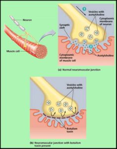 Foodborne Botulism being dispersed via the vascular system